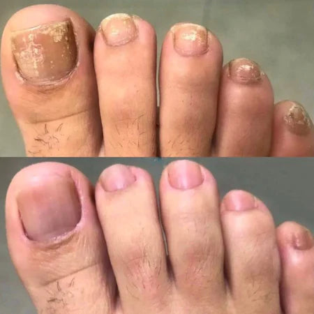 Bain de pieds SwissClear - Votre chemin vers des ongles plus sains