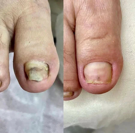 Bain de pieds SwissClear - Votre chemin vers des ongles plus sains