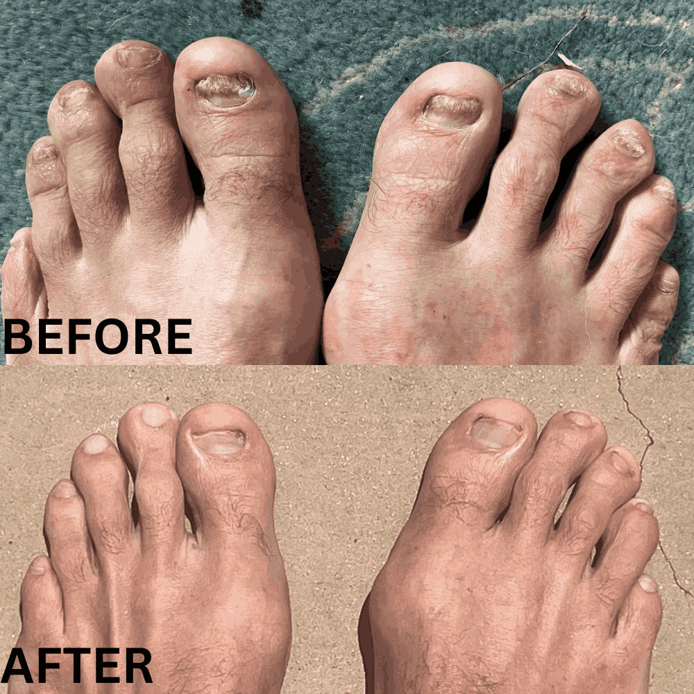 Appareil thérapeutique Swissclear™ : Votre chemin vers des ongles sans mycose
