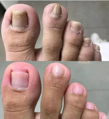 Bain de pieds SwissClear - Votre chemin vers des ongles plus sains