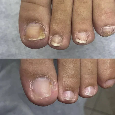 Bain de pieds SwissClear - Votre chemin vers des ongles plus sains