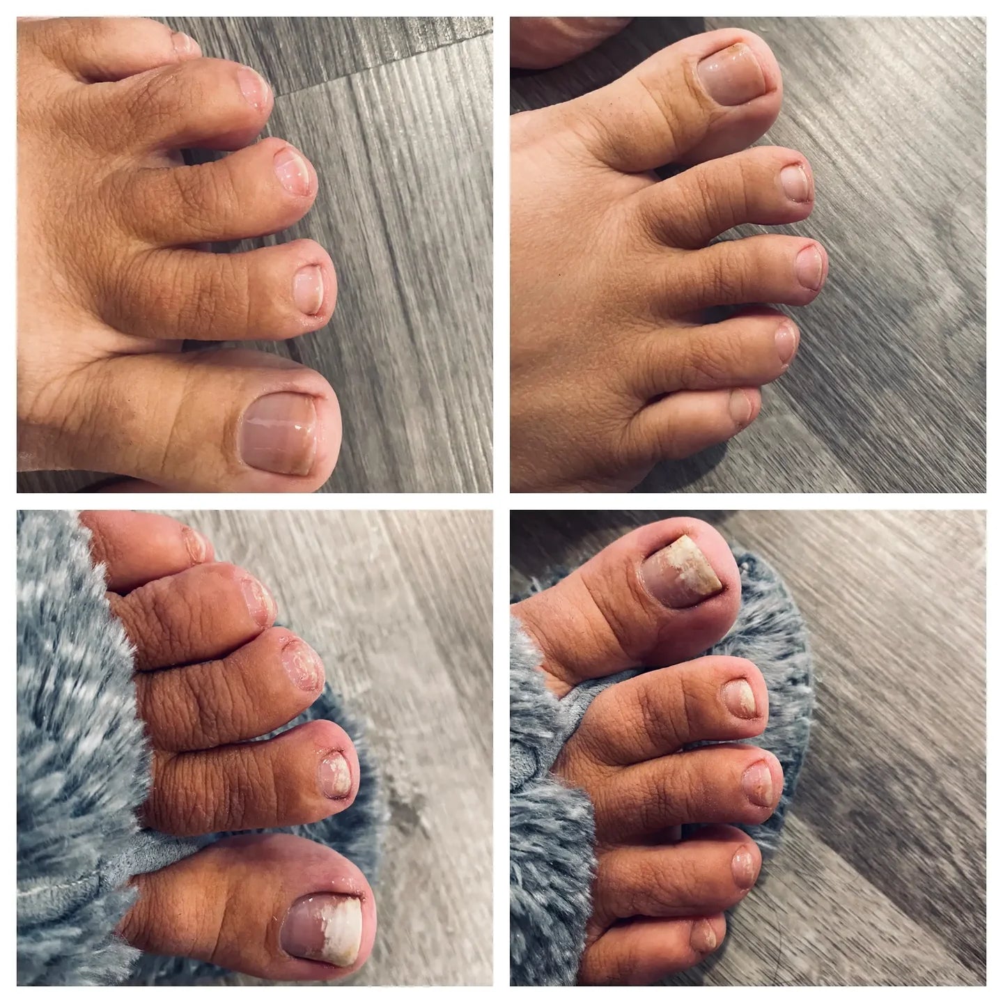 Appareil thérapeutique Swissclear™ : Votre chemin vers des ongles sans mycose