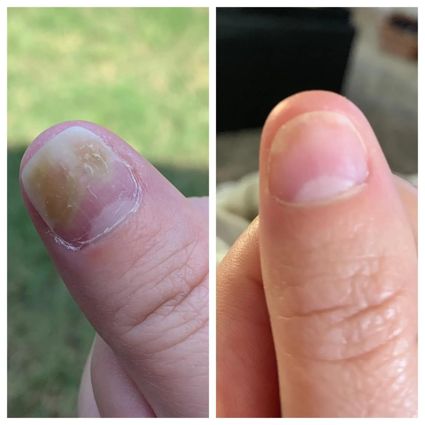 Appareil thérapeutique Swissclear™ : Votre chemin vers des ongles sans mycose