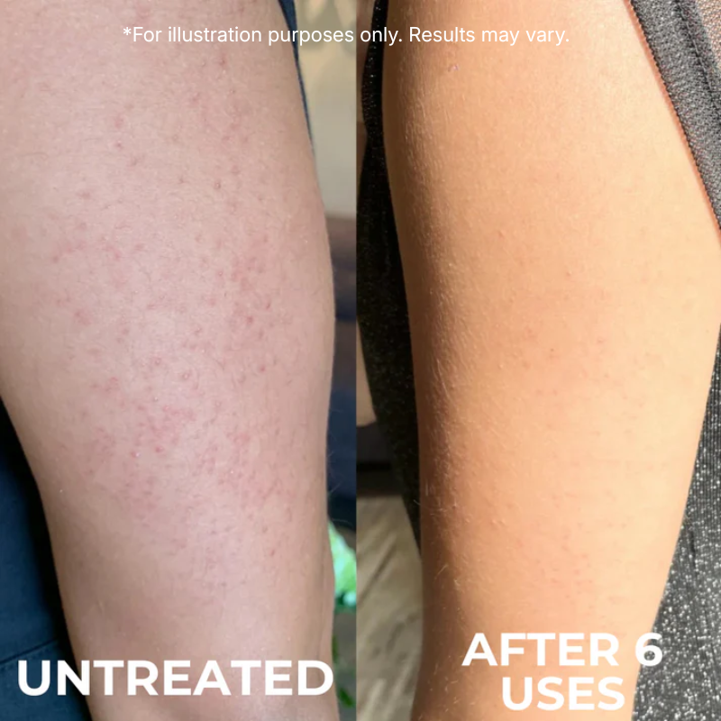 Advanced Triple-Acid Complex for Keratosis Pilaris