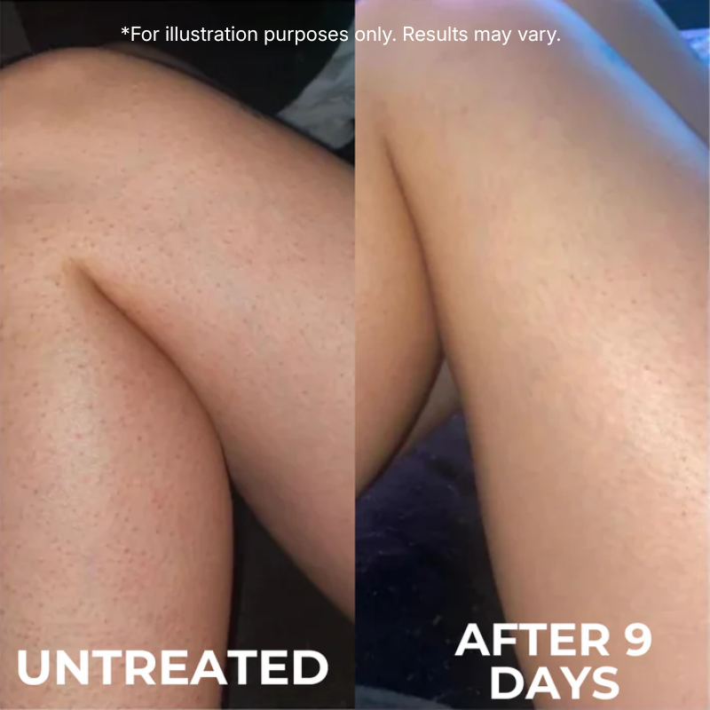 Advanced Triple-Acid Complex for Keratosis Pilaris