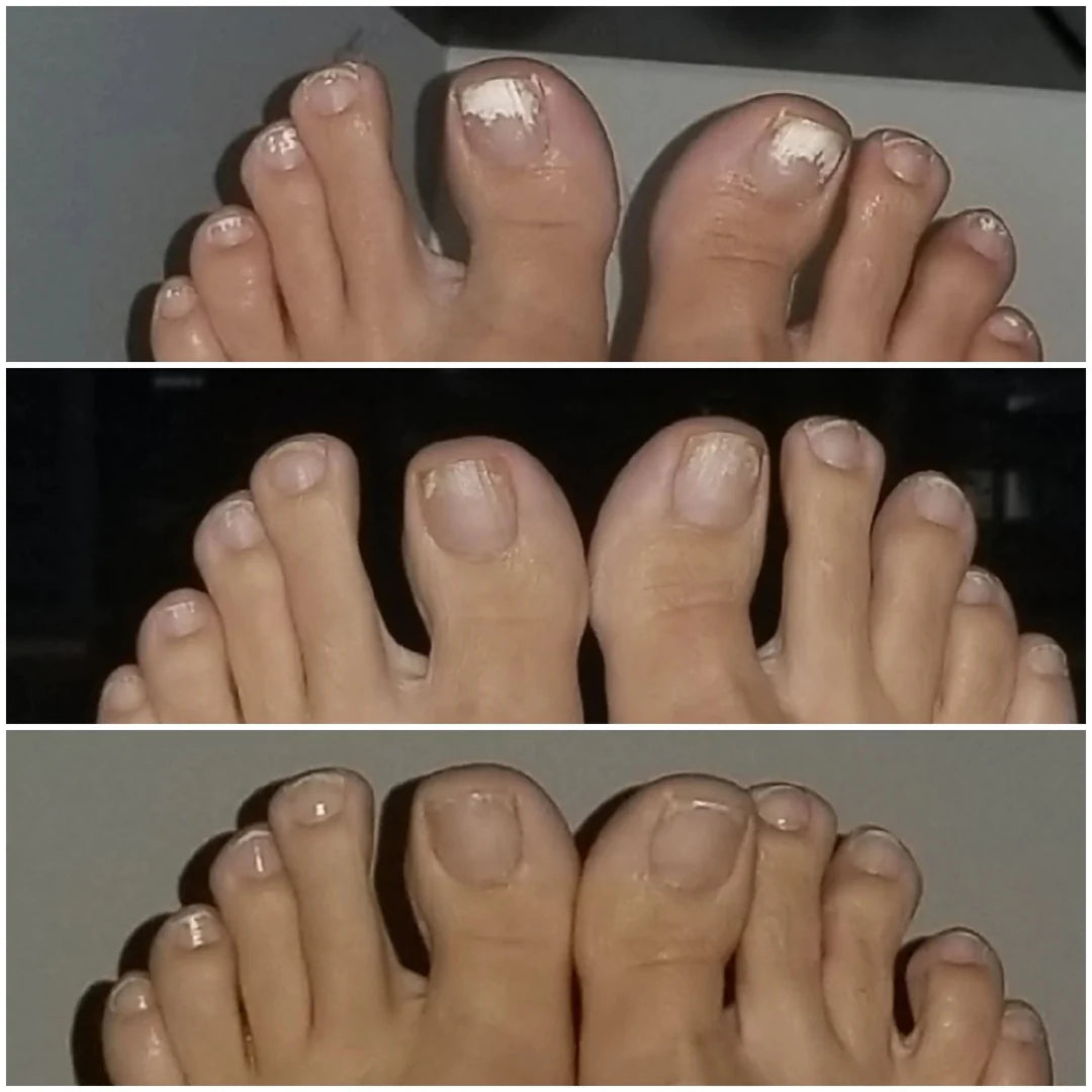 Appareil thérapeutique Swissclear™ : Votre chemin vers des ongles sans mycose