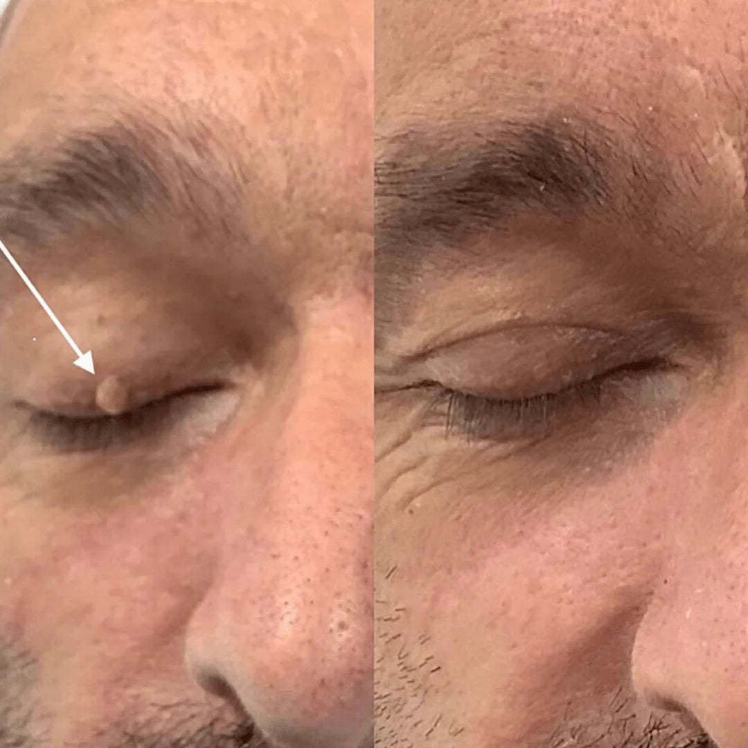 Stylo plasma Swissclear