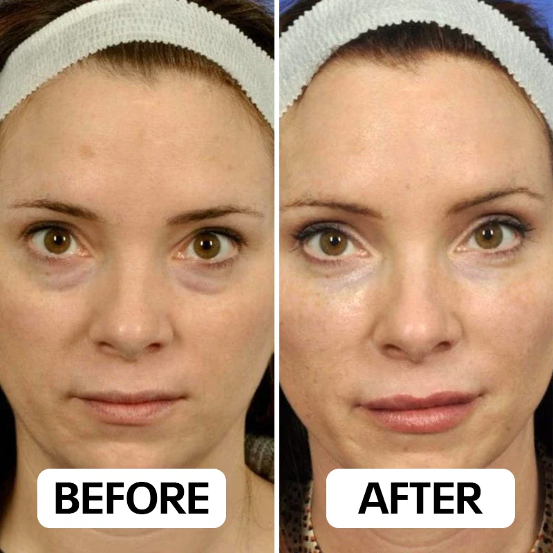 Combiné Neux Radiance™ de Neoclear