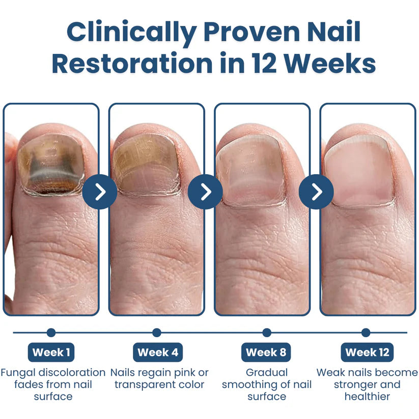 Appareil thérapeutique Swissclear™ : Votre chemin vers des ongles sans mycose