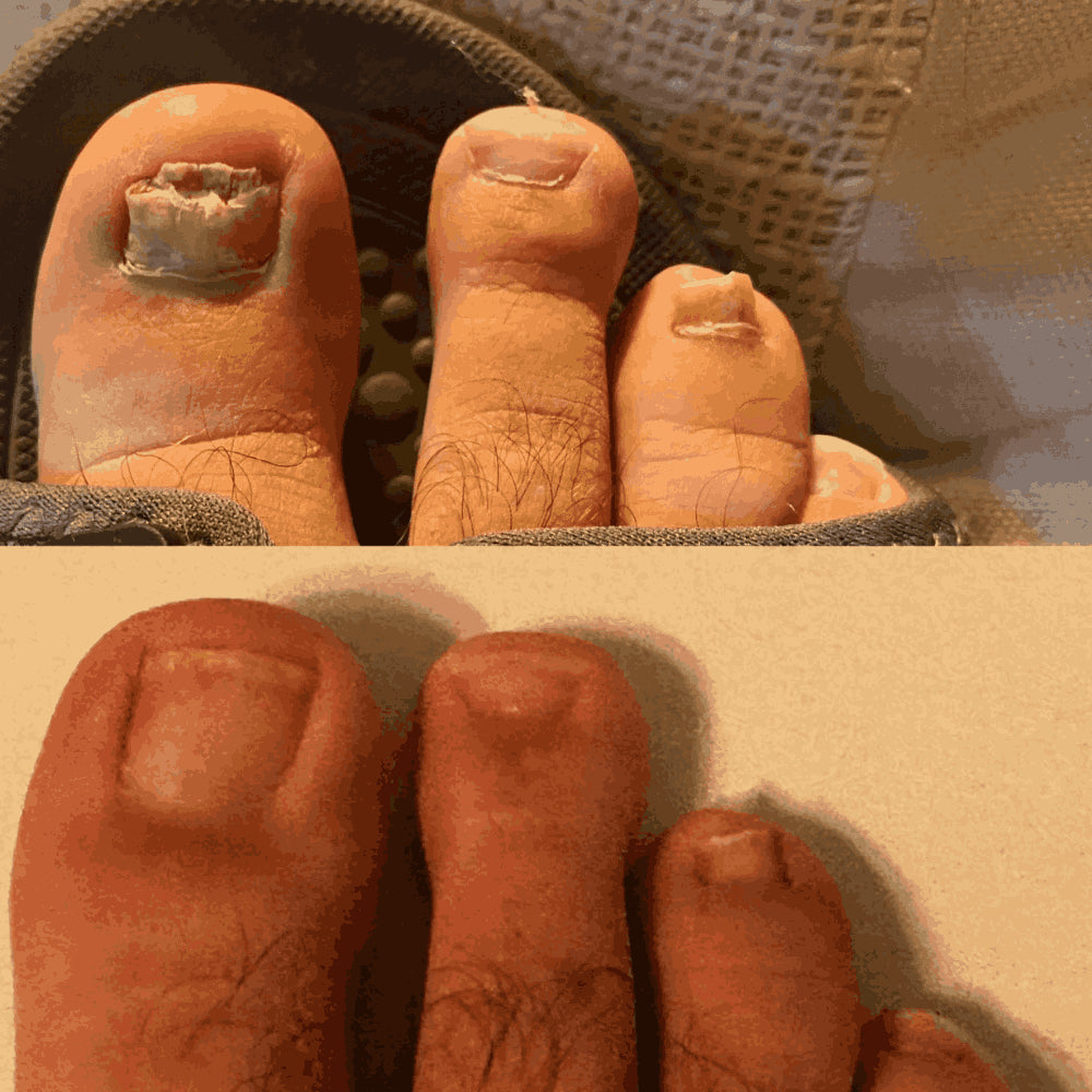 Appareil thérapeutique Swissclear™ : Votre chemin vers des ongles sans mycose